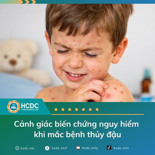 Thủy đậu là bệnh truyền nhiễm dễ lây lan trong cộng đồng